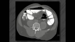 Small bowel disease  Ct enteroclysis [upl. by Ruffi]