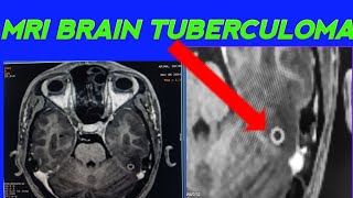 MRI BRAIN TUBERCULOMA CASE How to diagnose TUBERCULOMA in Mri Brain Tubercloma case [upl. by Naleek287]