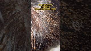 How to remove nits from hairlice removallice removal Treatment in Parlourhow to prevent lice [upl. by Richey62]