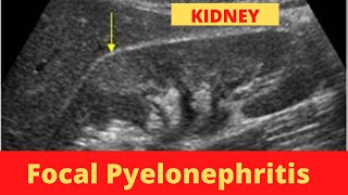 Focal Pyelonephritis  Ultrasound  Case [upl. by Rellia]