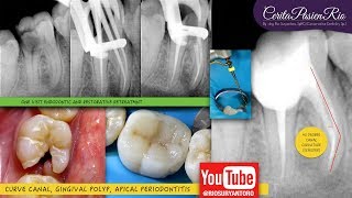 One curve micromega visit endodontic treatment gingival hyperplastic polyp electrosurgery [upl. by Ettelohcin]