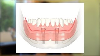 Eine kostengünstige Implantatlösung [upl. by Bithia]