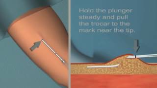 Jadelle insertion and removal Tutorial [upl. by Norehc881]