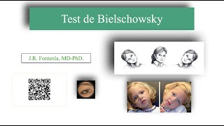 Test de Bielschowsky [upl. by Lobell]