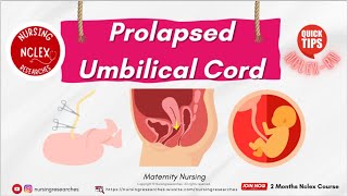 Prolapsed Umbilical Cord Maternity Nursing Nclex Quick tips [upl. by Hannad]