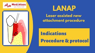 LANAP Laser assisted New Attachment procedure l Periodontal Regeneration l Mediklaas [upl. by Elita]