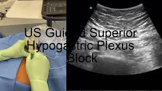 Ultrasound Guided Superior Hypogastric Plexus Block [upl. by Cia]