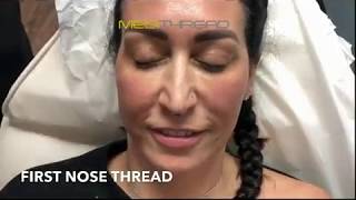 PDOTHREAD LIFT PROCEDURE BY MEDiTHREAD  Nose Lift [upl. by Flavia]