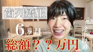 【歯科矯正6ヶ月後】30代女性・歯列矯正費用・途中経過総額◯◯万円 [upl. by Ayatan]