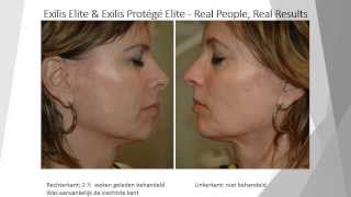 Resultaten Exilis Elite [upl. by Anauqaj]