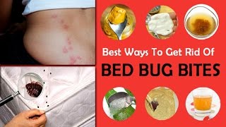 How to Treat Bed Bug Bites With Home Remedy [upl. by Eiramik]