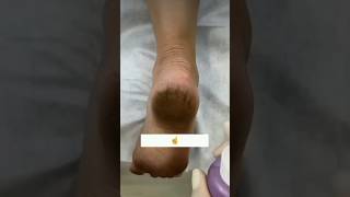 👠Get Rid Of Cracked HeelsRepair Cracked Heels In 1Day cracked heels feetcare youtubeshorts [upl. by Lowson932]