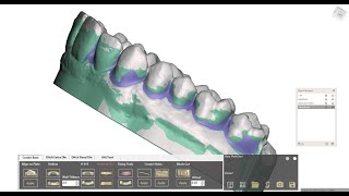 Blockout Dental model with MeshDentBaseCreator [upl. by Ecila]