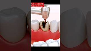 caries removal shorts viral asmr [upl. by Steffin]