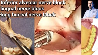 Local Anesthesia Inferior Alveolar Nerve block amp long buccal Nerves block Mandibular nerve block [upl. by Aihsel152]