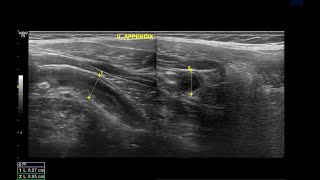 Acute Appendicitis  Ultrasound  Case 12 [upl. by Mattheus]