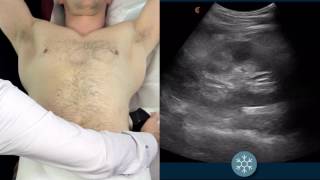 How to scan the kidneys using wireless ultrasound [upl. by Revned]