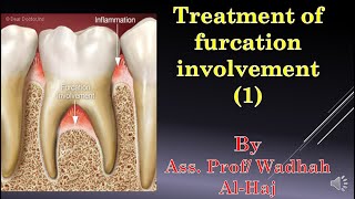 45Periodontal surgery14 Furcation involvement1Dr Wadhah Periodontology lecturesد وضاح الحاج [upl. by Obeded]