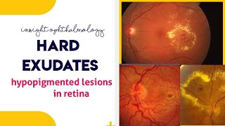 HARD EXUDATES  Hypopigmented lesions of the retina [upl. by Rondi338]