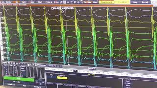 AVNRT Ablation [upl. by Lossa]