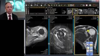 MRI Case Review Shoulder Deep Dive [upl. by Htebsil]