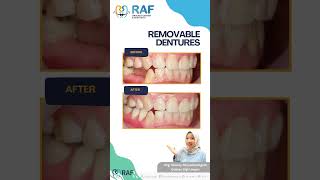 Removable dentures valplast gigitiruan dentist [upl. by Anitsyrc]