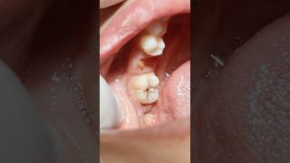 Print technique composite restoration for lower second molar tooth [upl. by Neelyhtak839]