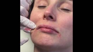 Dermal Filler with Neauvia  Organic Collagen stimulating filler [upl. by Nnewg]