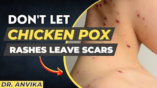 Hindi  Don’t Let Chicken Pox Rashes Leave Scars  By MD Dermatologist Dr Anvika [upl. by Chemash]