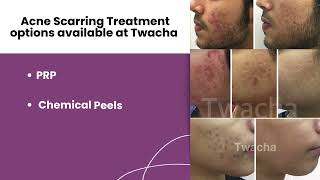 Acne Scarring Treatment l Acne Scars l Acne Marks l Dark Spots l Skin Clinic l Twacha l Dwarka [upl. by Ahseikram]