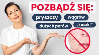 PRYSZCZE WĄGRY ŚWIECENIE  przyczyny i skuteczne metody na pozbycie się ich [upl. by Teresita]