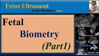 Fetus Ultrasound Fetal BiometryPart1 [upl. by Juanne199]