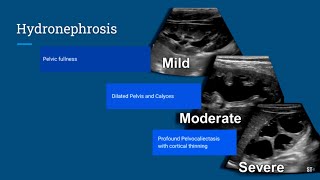 Hydronephrosis Ultrasound [upl. by Nixie]