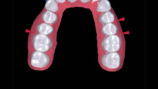 ClearCorrect 173125 NC25 Orthodontics Orthodontie Sherbrooke Invisalign Clincheck [upl. by Liatris]