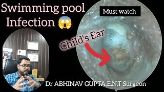 Microsuction Magic Clearing Swimmers Ear Infection in a Child [upl. by Lorna]