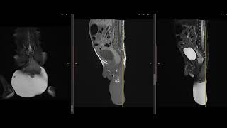 case 18 2 weeks baby born with swelling [upl. by Auqinehs222]