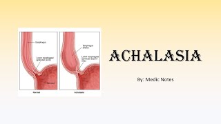 Achalasia  clinical features investigation manometry findings medical and surgical treatment [upl. by Ennavoj]