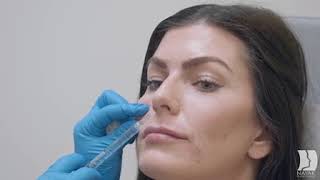 Filler injections to lips and nasolabial folds [upl. by Akehsar]