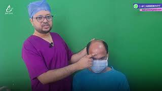 Grade 6 Baldness Fue Hair Transplant Marking amp Planning  Dr Jayanta Bain Kolkata [upl. by Cox559]