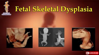 Fetal Skeletal Dysplasia [upl. by Boffa]