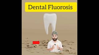 Dental Fluorosisक्या हैFluoride teeth treatmentytytshorts shorts dentalclinicdentist in Patna [upl. by Sato]