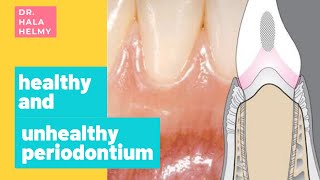 Detect your periodontium   2 Healthy and Unhealthy periodontium [upl. by Ecnadnak]