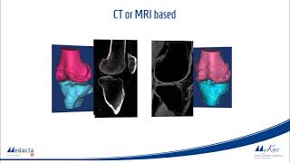 Medacta MyKnee 3D Printed PatientSpecific Guides [upl. by Lledroc]