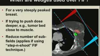 Basics of Breast Cancer Radiotherapy Treatment Planning [upl. by Anaet399]