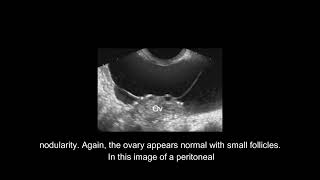 Sonographic Evaluation of The Ovary and Adnexa [upl. by Lohner484]