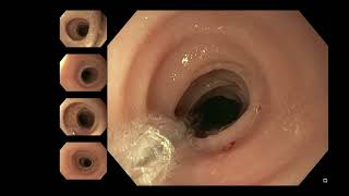 Eosinophilic Oesophagitis Stricture Dilatation [upl. by Rayner]