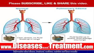 Pulmonary edema   Causes Symptoms Diagnosis Treatment Prevention [upl. by Khichabia]