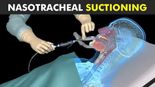 How Nasotracheal Suctioning Is Performed [upl. by Boehmer100]