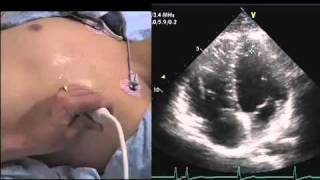 Intro to Echo Apical 4 Chamber Viewmov [upl. by Fineman]