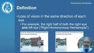 Understanding Homonymous Hemianopia Causes Symptoms and Treatment  Visual Impairment Explained [upl. by Oralee]